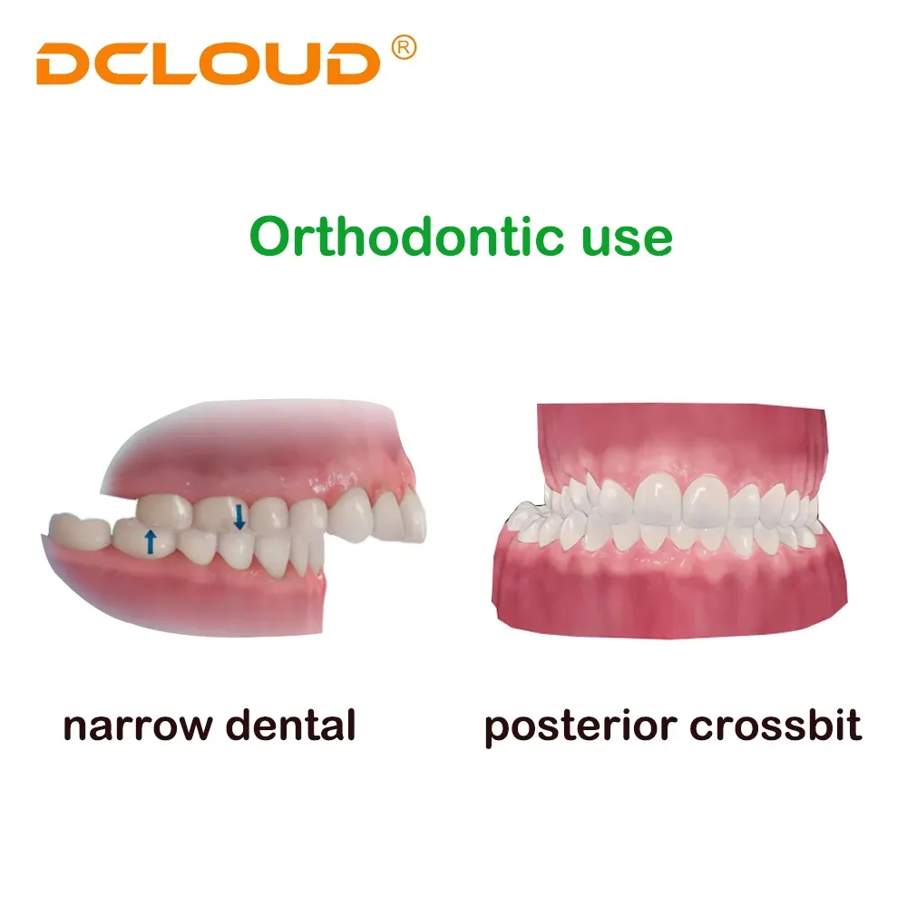 Dental Orthodontic Expansion Screw Stainless Steel Frame Rapid Palatal · Image 6
